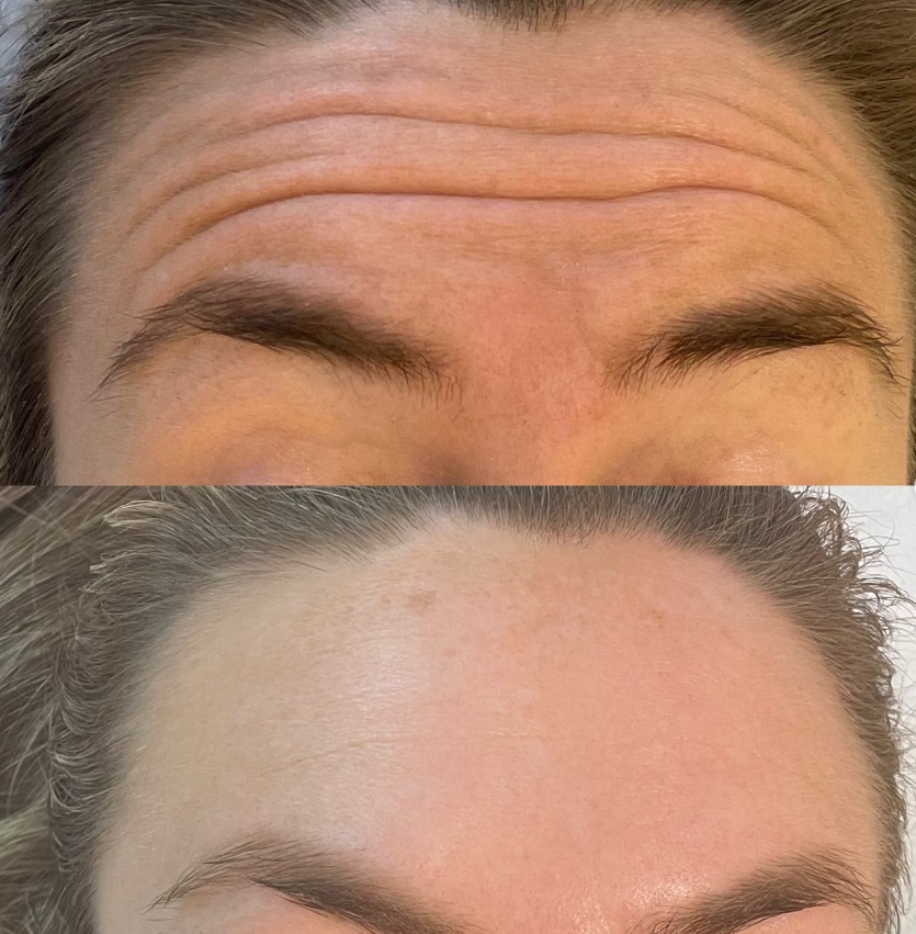 Botox armhåla i Östermalm - Boka tid idag