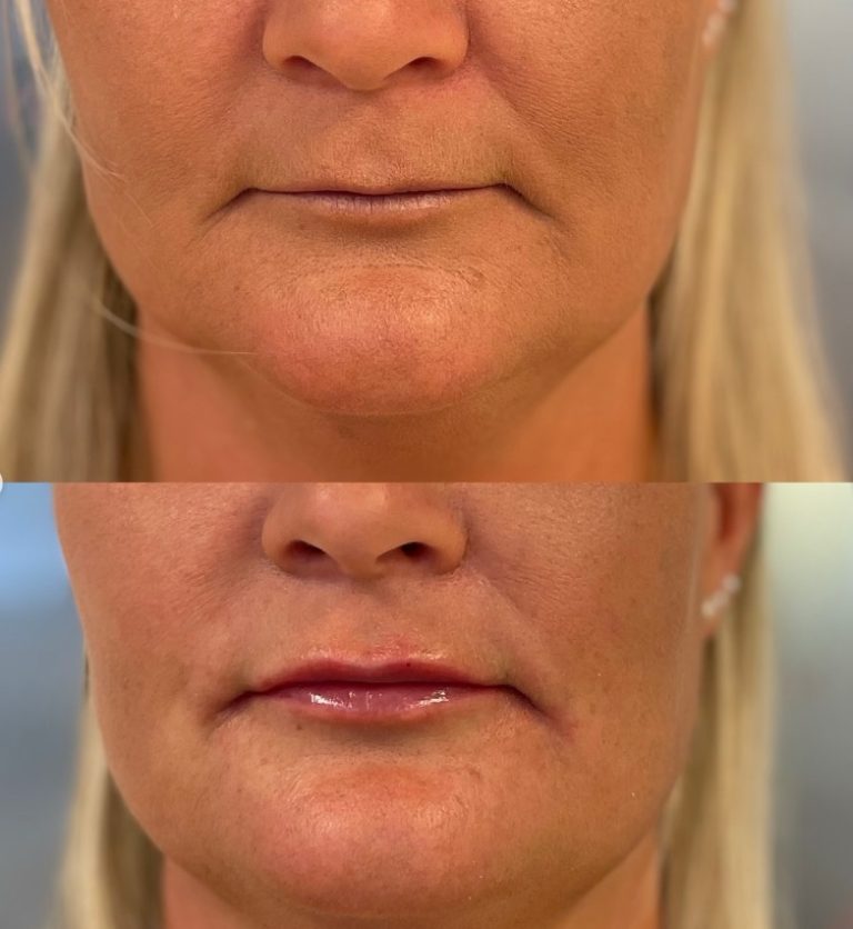 Kvalitativ Botox armhåla i Östermalm