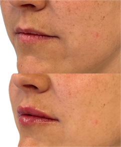 Goda resultat inom Botox armhåla för dig i Östermalm
