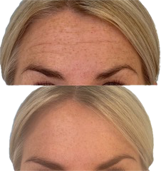 Bästa Botox armhåla för dig i Östermalm