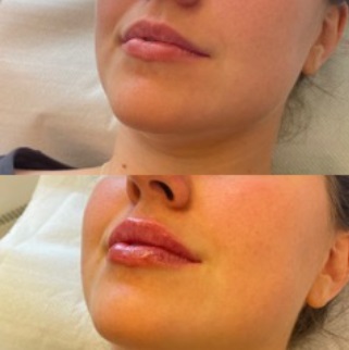 Prisvärd Botox armhåla i Östermalm av hög kvalitet