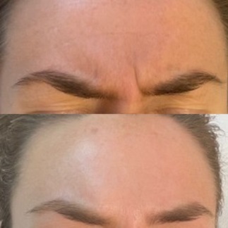 Högkvalitativ Botox armhåla i Östermalm