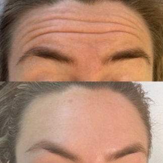 Specialiserad skönhetsklinik i Östermalm för Botox armhåla