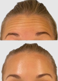 Östermalm´s främsta Botox armhåla
