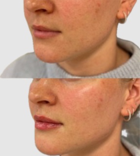 Botox armhåla i Östermalm - Kom förbi idag