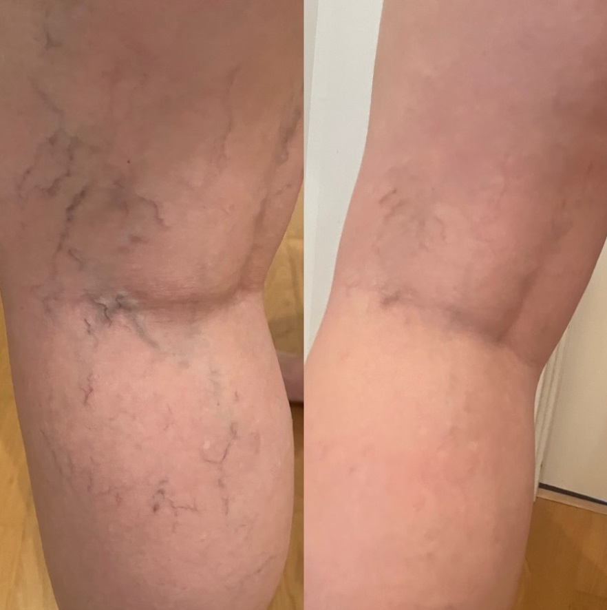 Professionell Botox armhåla i Östermalm