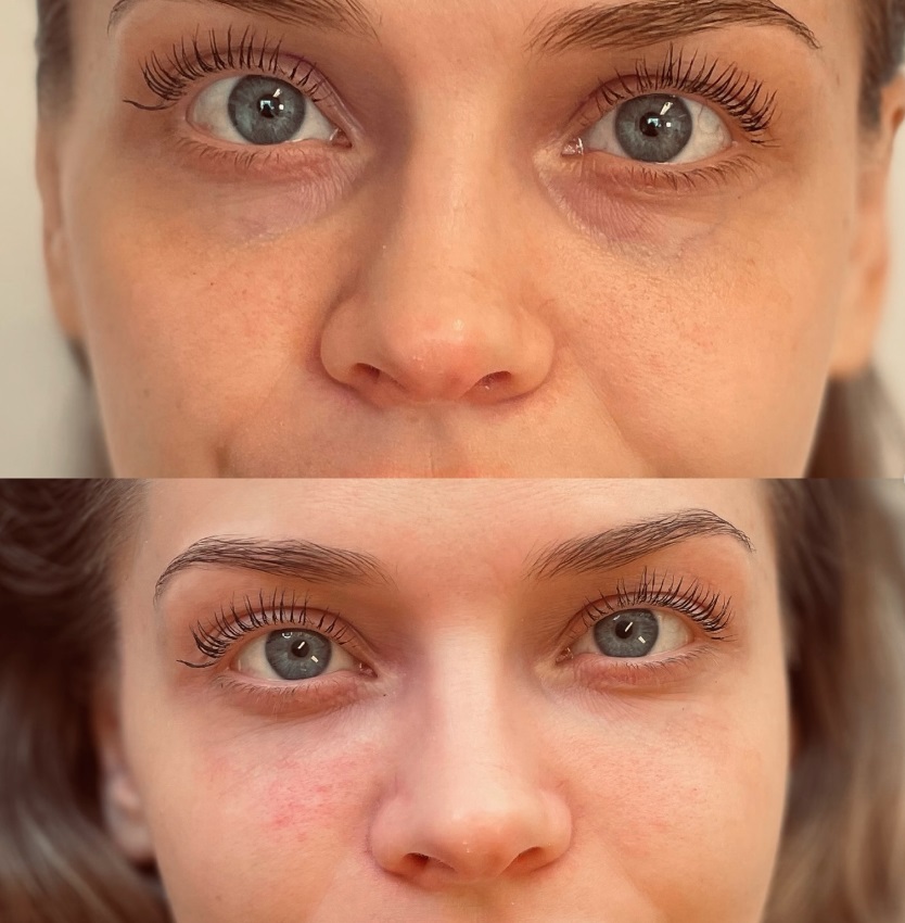 Botox armhåla i Östermalm - Boka din service idag